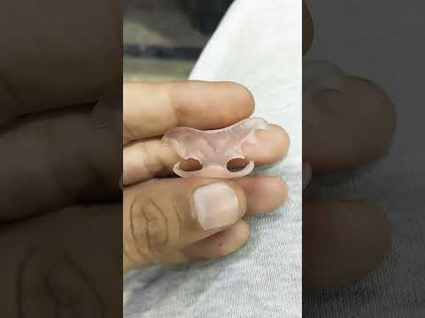 Single Unit Flexible Partial Denture By Haider 😁😁😁#flexible#partialdenture#viralvideo #shortvideo