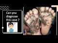 Itchy papules on feet | Can you diagnose this case| Case 7