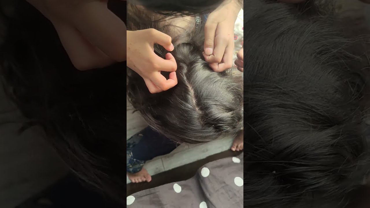 Removed Many Lice In Short Hair||ASMR Pakistan