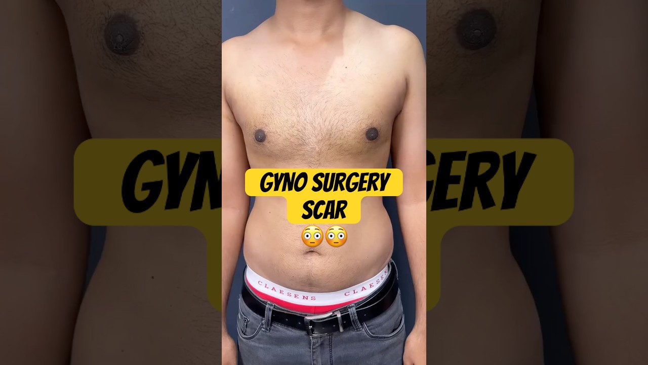 3 Wks After Gynecomastia Surgery: Scars, Swelling & Massage Explained! | Dr.DC Plastic Surgeon Pune