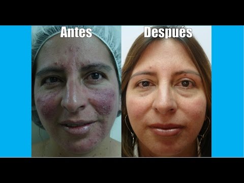 Tratamiento de  casos curados de acné rosacea y noduloquistico | Tratamiento Rosacea Bogotá