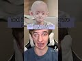 Progeria