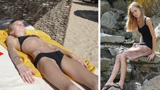 My Eating Disorder Story