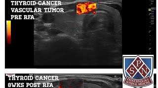 Papillary Thyroid Cancer follow up 8 weeks post thyroid RFA