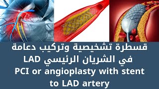 قسطرة تشخيصية وتركيب دعامة Coronary artery angioplasty and Percutaneous coronary intervention (PCI) screenshot 1