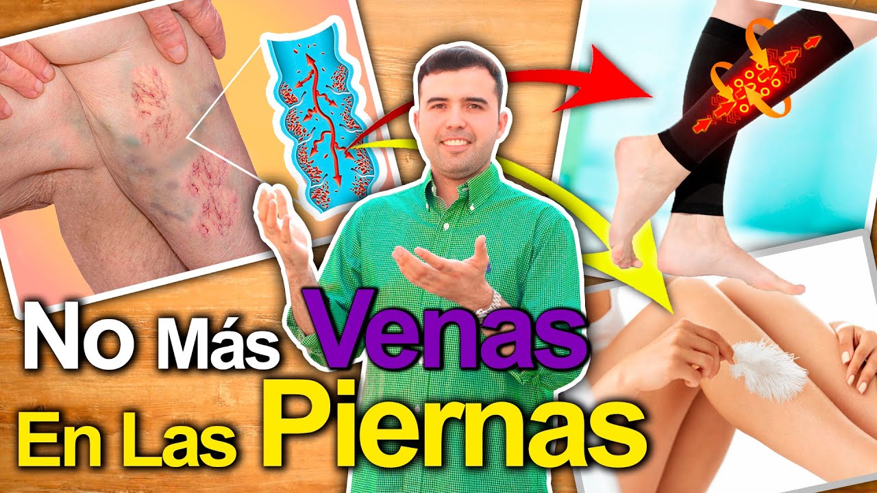 Cura Las Varices De Una Vez Por Todas - Como Eliminar Las Venas Varicosas Y Mejorar Circulacion