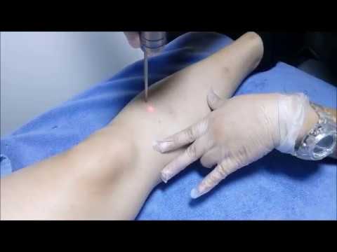 My Legs journey to Flawless Skin: The story continues: Episode 2 - Laser White Treatment