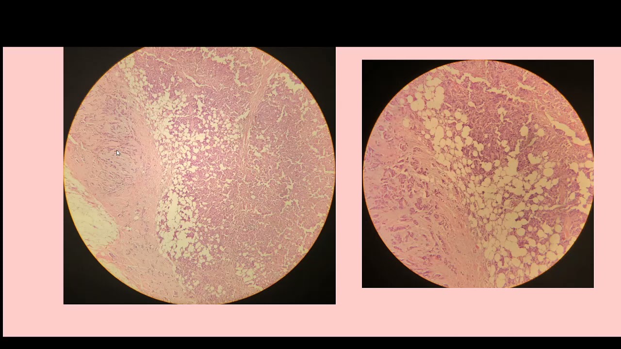 Дольковый рак молочной железы