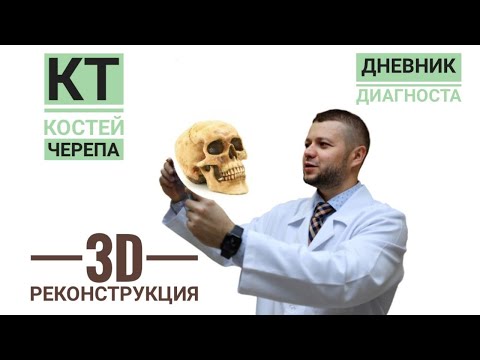 КТ костей черепа с 3D-реконструкцией