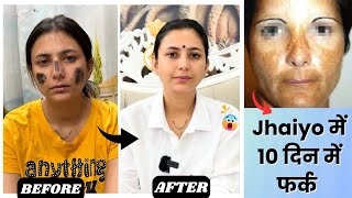 How to cure Pigmentation permanently and get Brighter Skin | Jhaiya, Melasma Skin Whitening Remedies screenshot 4