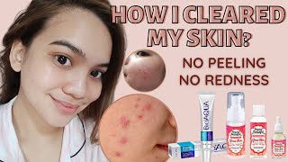 HOW TO REMOVE PIMPLES WITHOUT PEELING & REDNESS | Beyond Beautiful • BioAqua Review