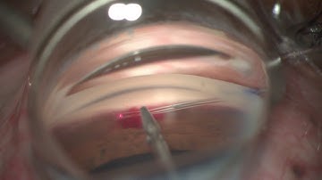 Managing challenges of iTrack™ canaloplasty: Bleeding Obscures View