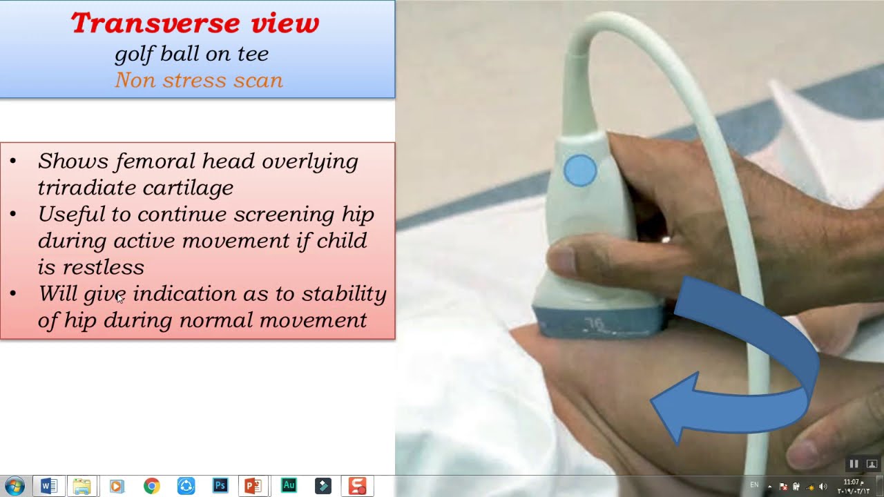 Radiology case (2) :: Ultrasound of developmental dysplasia of hip joint (DDH) :: Dr.Mohamed soliman