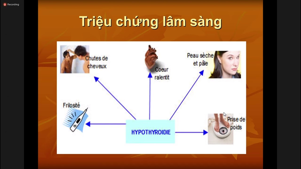 Lý thuyết : Suy Giáp - PGS.TS Vũ Bích Nga