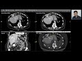 Spectral Imaging - Liver Post TACE