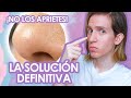 COMO ELIMINAR los FILAMENTOS SEBACEOS : Recomendaciones de un dermatologo