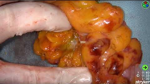 Stryker SPY OPEN Colorectal with Perfusion Quantification