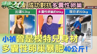 小禎曾是模特兒身材 多囊性卵巢暴肥40公斤 健康2.0