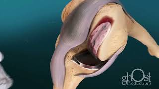 Ghost Productions - 2014 Orthopedic Demo Reel