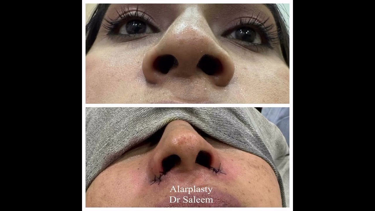 Thick nose  treatment with rhinoplasty by dr Saleem