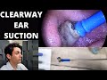 Soft Tip Suction Probe Used to Extract Dead Skin From Ears (Clearway Suction Tool)