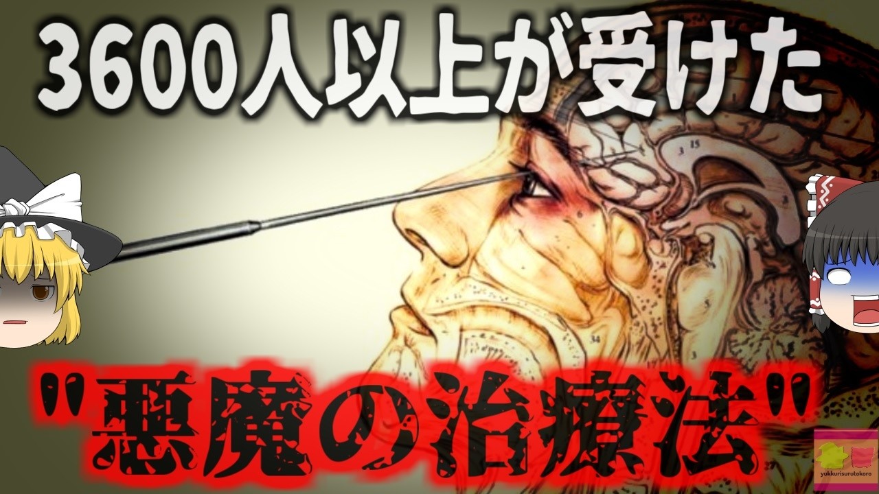 “史上最悪のノーベル賞”「これで狂人も正気に戻った」患者の脳に3500回もアイスピックを突き刺した悪魔の治療法と呼ばれた術式…『ウォルター・フリーマン』【ゆっくり解説】