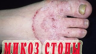 ★Лечение МИКОЗА (грибка) стопы. Ценные советы для избавления от грибка на ногах. ★Лечение МИКОЗА (грибка) стопы. Ценные советы для избавления от грибка на ногах.