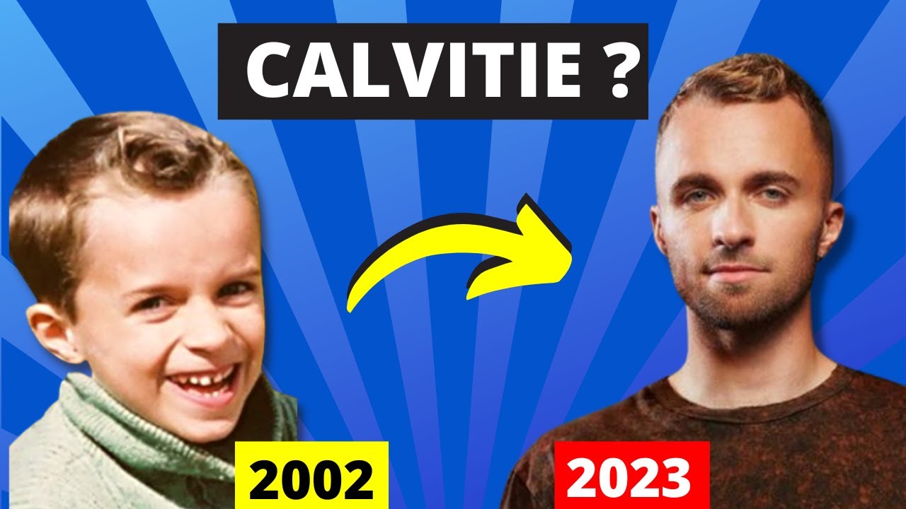 Squeezie a t'il vraiment une calvitie ? Enfin La vérité sur sa 
