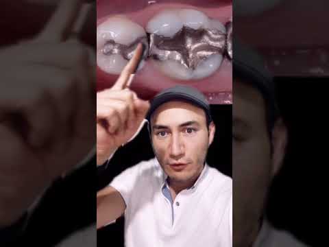 Video: ¿Por qué pulir la amalgama después de 24 horas?
