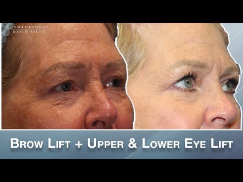 Eye Lift and a Brow Lift - Patient Testimonial Included!