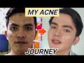 PAANO AKO KUMINIS - MY ACNE JOURNEY (MJ GARCIA PEREZ)