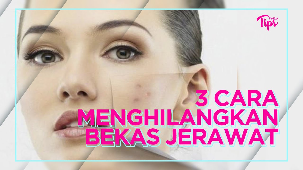 3 Cara Menghilangkan Bekas Jerawat Membandel 