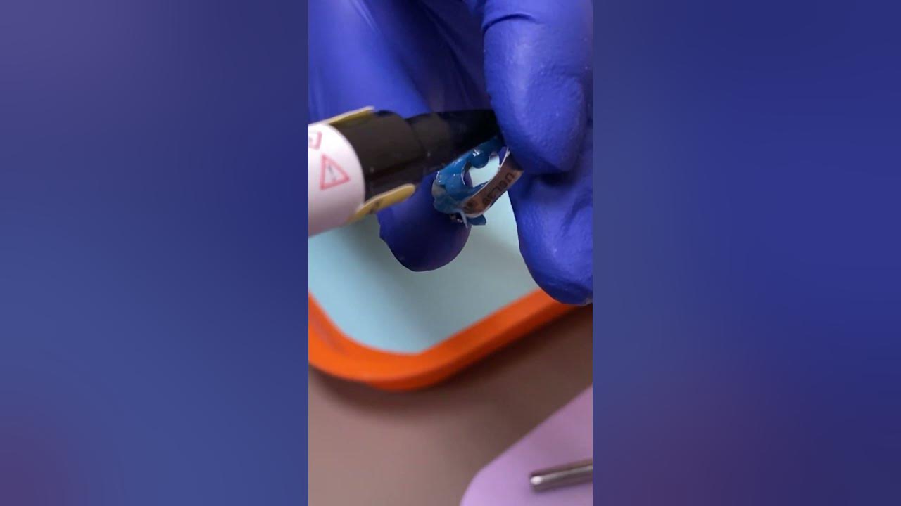 Loose Molar Band Molar Bands Pain Tooth Time Family Dentistry New Braunfels Texas YouTube