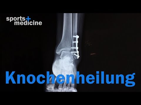 Video: Wie man gebrochene Knochen heilt: Im Krankenhaus, zu Hause und in der Rehabilitation