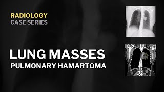 Pulmonary hamartoma | Radiology | truefisp