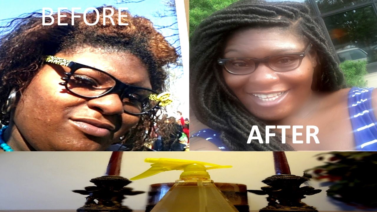 diy toner for hyperpigmentation