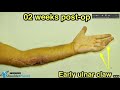 SEVERE FOREAM 0PEN-WOUD MUSCULAR LACERATION - TIPS FOR MUSCLE SUTURES