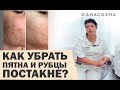 ПОСТАКНЕ 🔥 КАК УБРАТЬ ПЯТНА И РУБЦЫ ПОСЛЕ ВЫСЫПАНИЙ? | Федоряченко Оксана