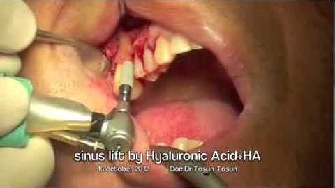 Simultaneous Implant Placement & Sinus Lift by Hyaluronic Acid + Hydroxyapatite and Early Loading