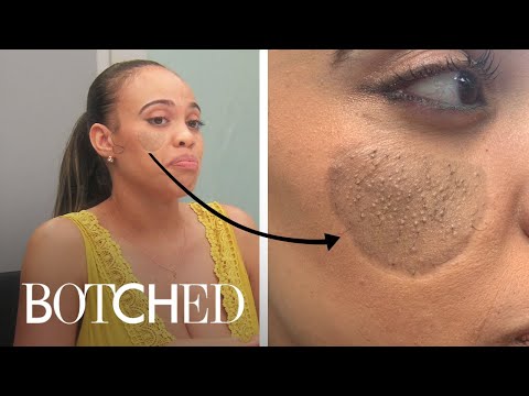 dog-bite-victim-has-"pubic-hair"-growing-on-her-face-|-botched-|-e!