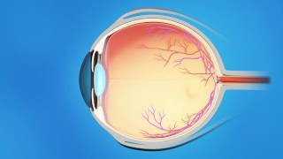 Laser Trabeculoplasty for Glaucoma