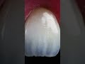 Aesthetic Anterior Tooth Restorations