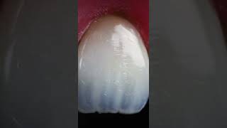 Aesthetic Anterior Tooth Restorations