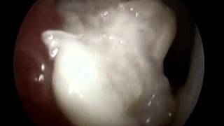 Arthroskopische Operation Grosser Ocd-Chips Bei Einem Pferd