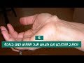 5 نصائح للتخلص من كيس اليد الزلالي دون جراحة