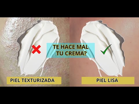 Video: ¿Puede la crema hidratante causar acné?