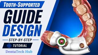 Tooth-Supported Surgical Guide Design in RealGUIDE | Step-by-Step Tutorial