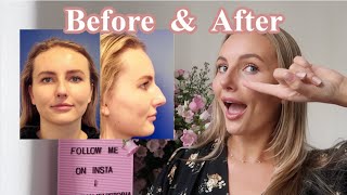 1 YEAR POST OP // My Septoplasty & Rhinoplasty Journey - Pt 6