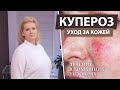 Лечение купероза на лице в домашних условиях. Купероз - что это?