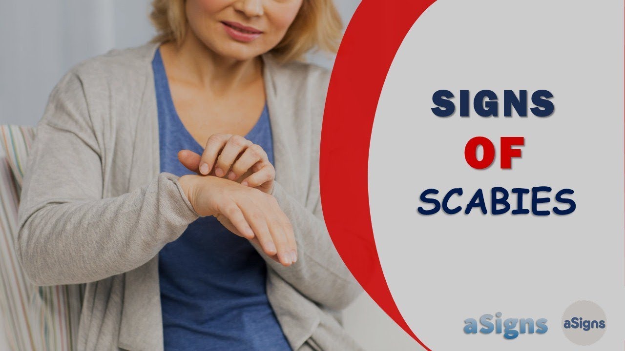 10 Signs Of Scabies Youtube